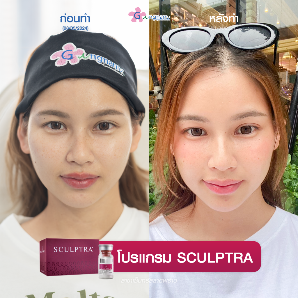 รีวิวฉีด Sculptra ที่กังนัมคลินิก