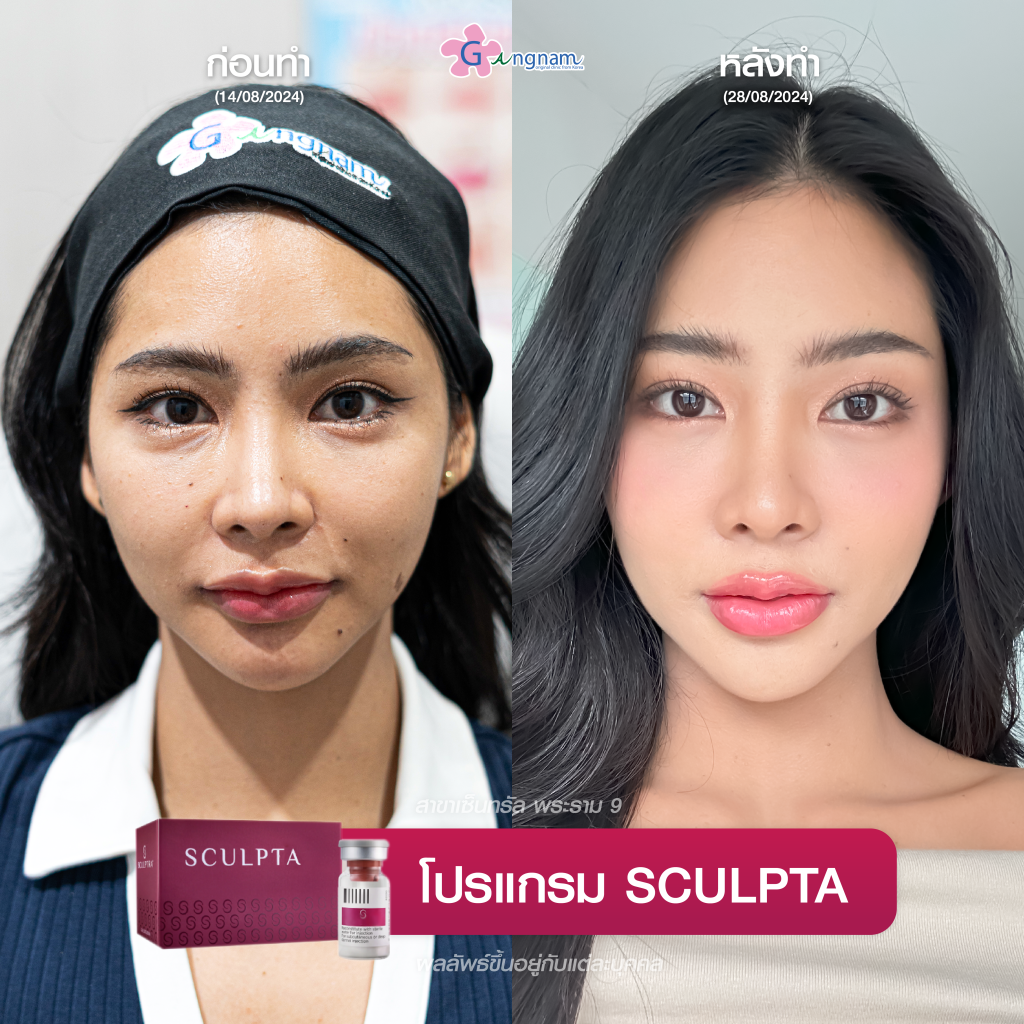 รีวิวฉีด Sculptra ที่กังนัมคลินิก