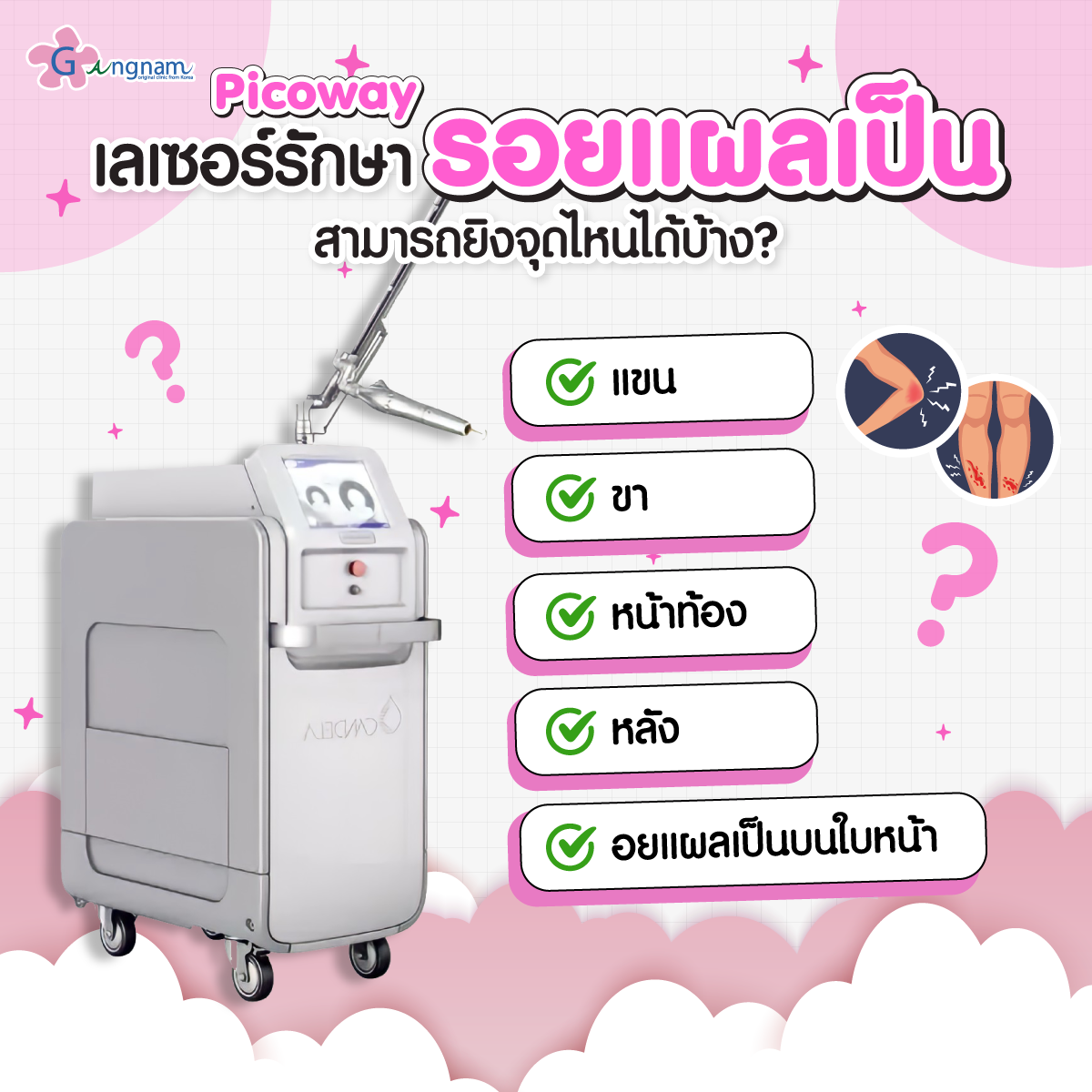 Picoway เลเซอร์รักษารอยแผลเป็นสามารถยิงจุดไหนได้บ้าง 