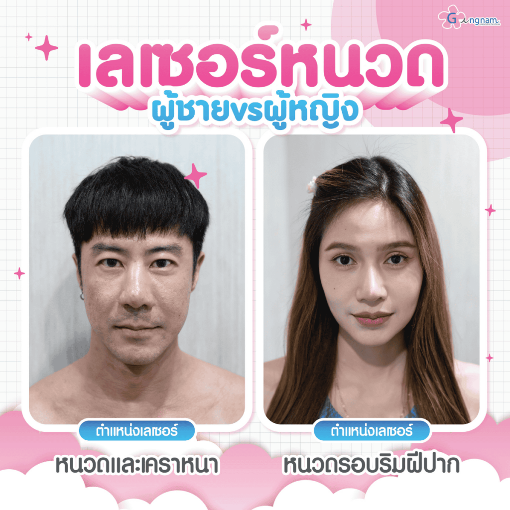 เลเซอร์หนวดผู้หญิงทำได้ไหม? และต่างกับเลเซอร์หนวดผู้ชายอย่างไร?