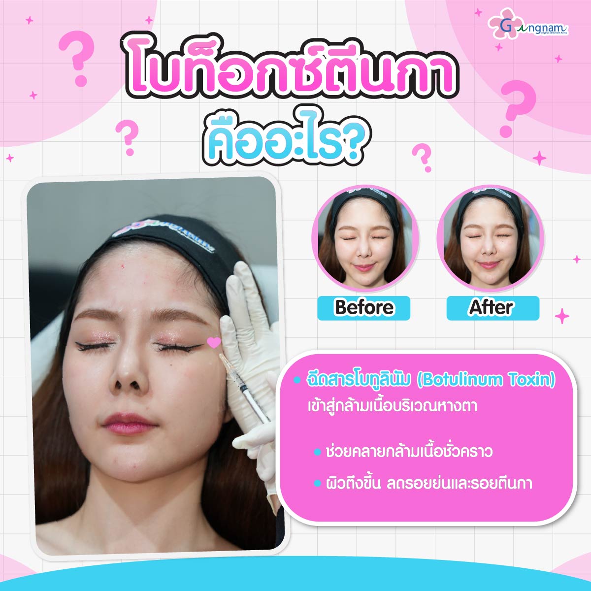 โบท็อกซ์ตีนกาคืออะไร