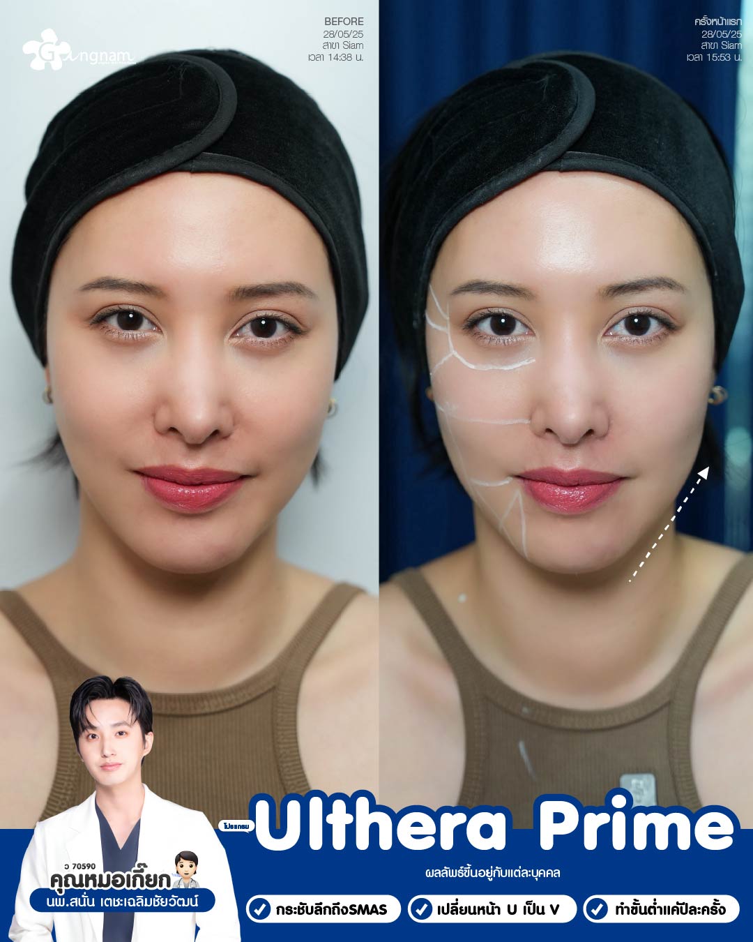 Ulthera Prime – ภาพโปรโมต 04