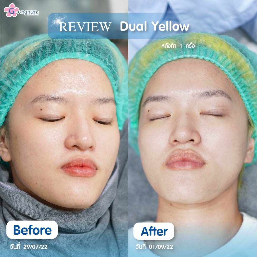 Dual Yellow Review 1