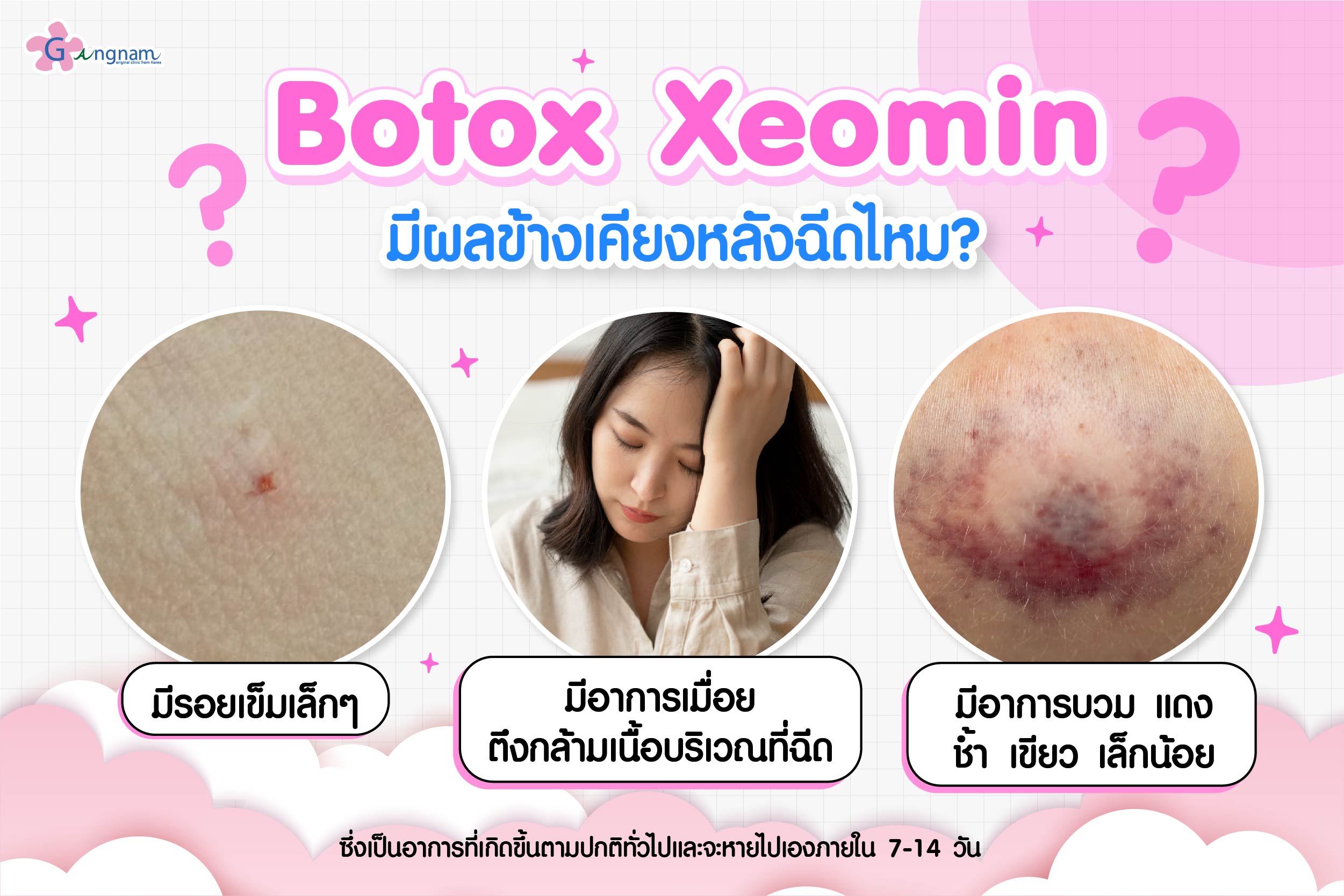 ฉีดโบท็อกซ์ Xeomin มีผลข้างเคียงหลังฉีดไหม?