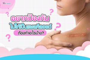อยากป้องกันไม่ให้เป็นแผลคีลอยด์