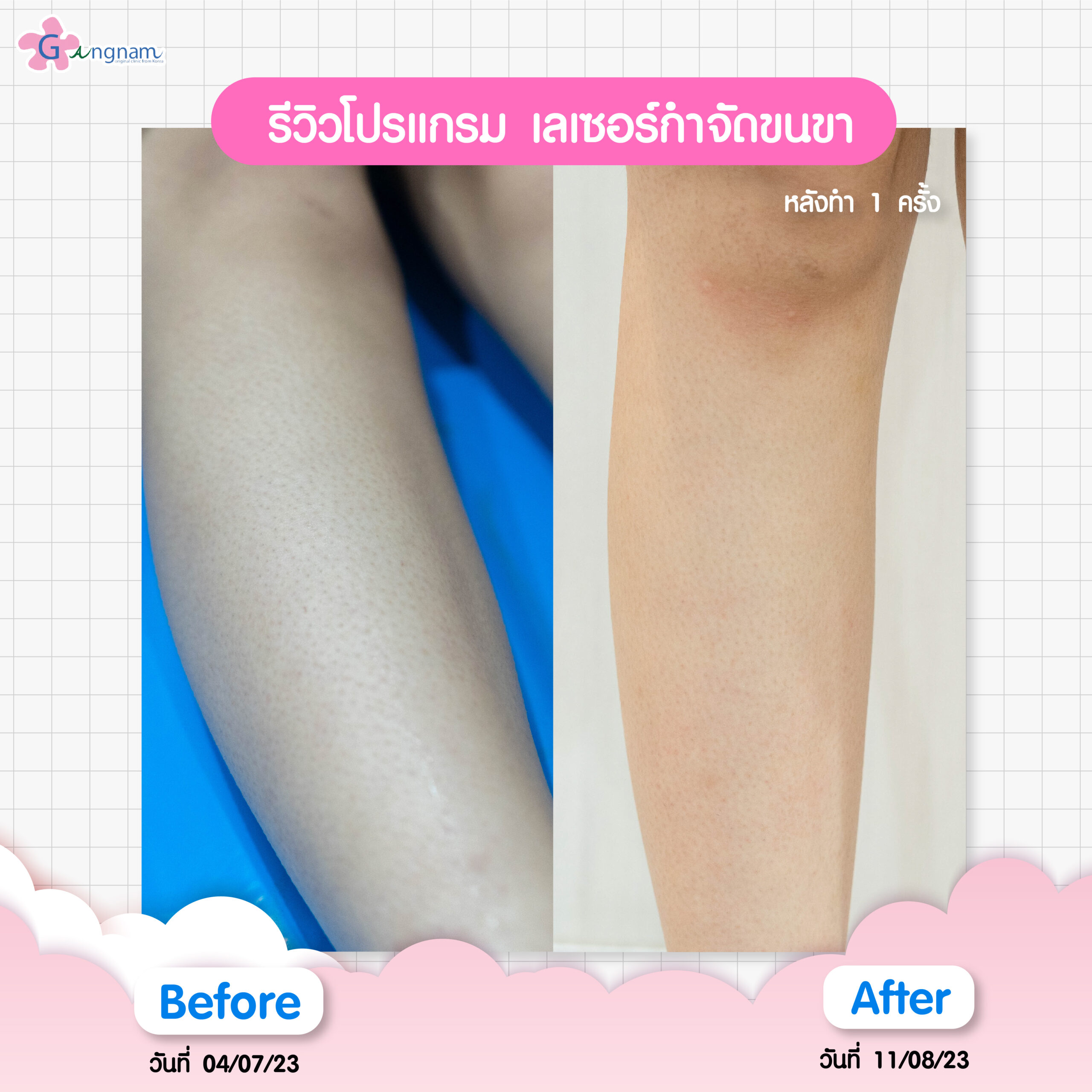 รีวิวเลเซอร์ขนขา 7