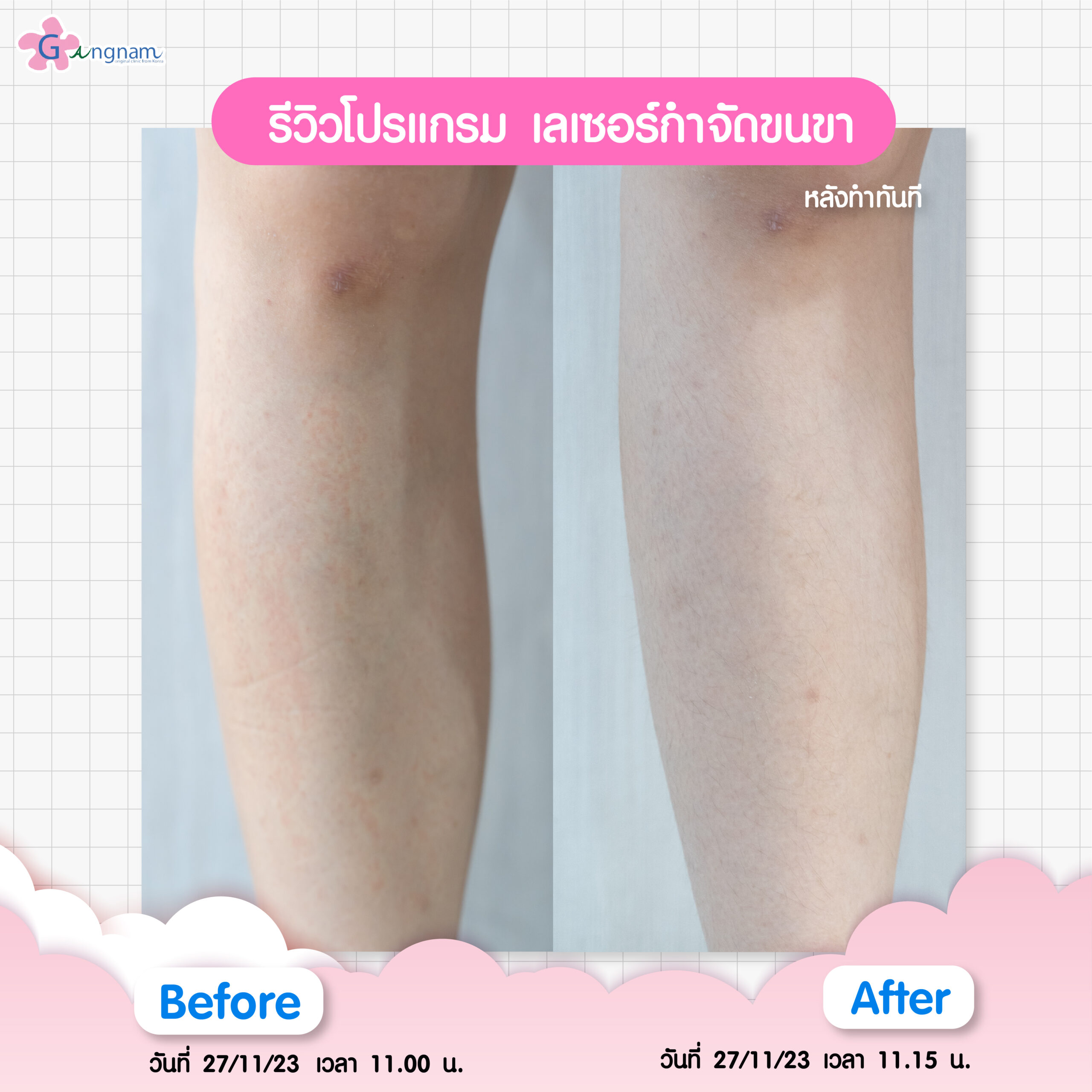 รีวิวเลเซอร์ขนขา 3
