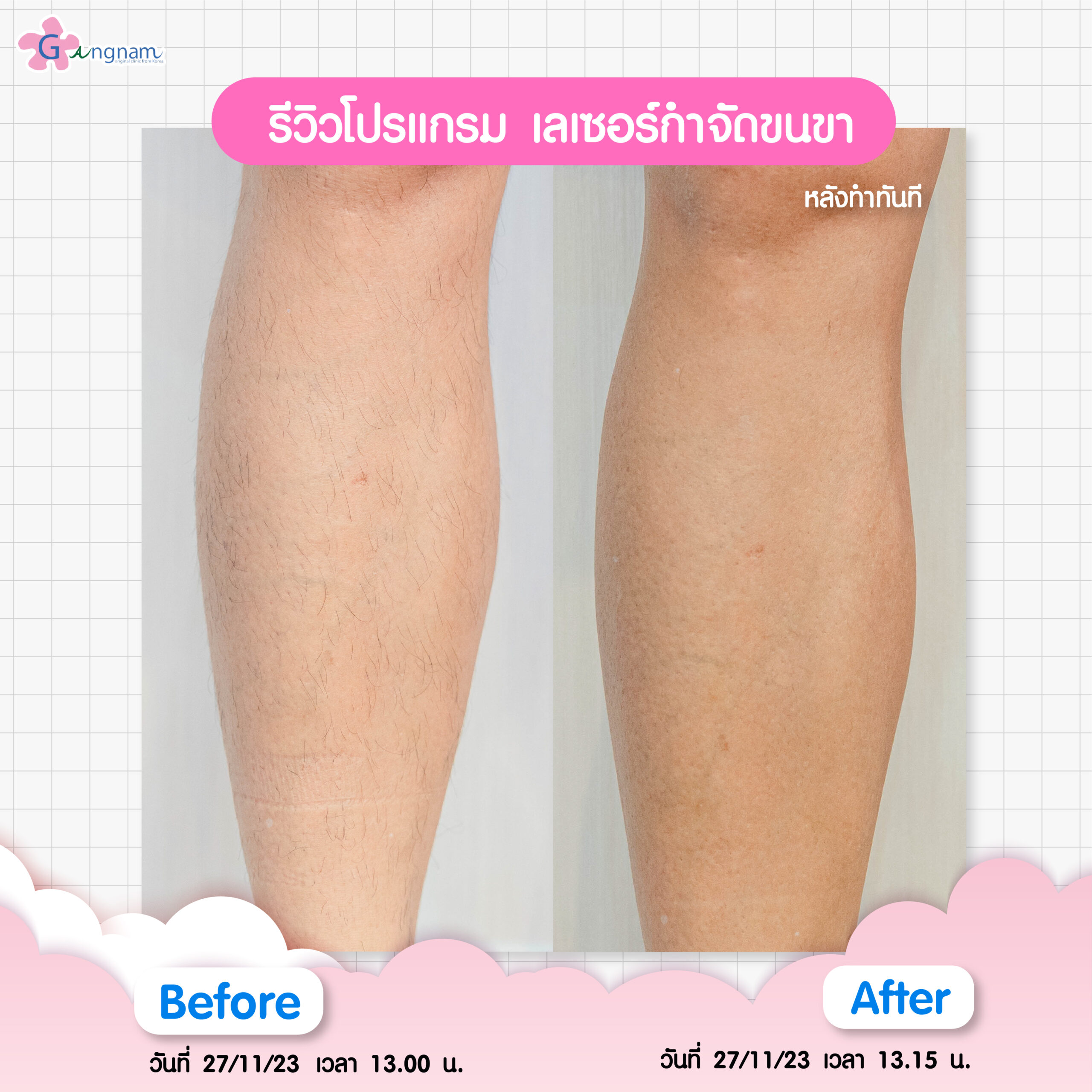 รีวิวเลเซอร์ขนขา 6