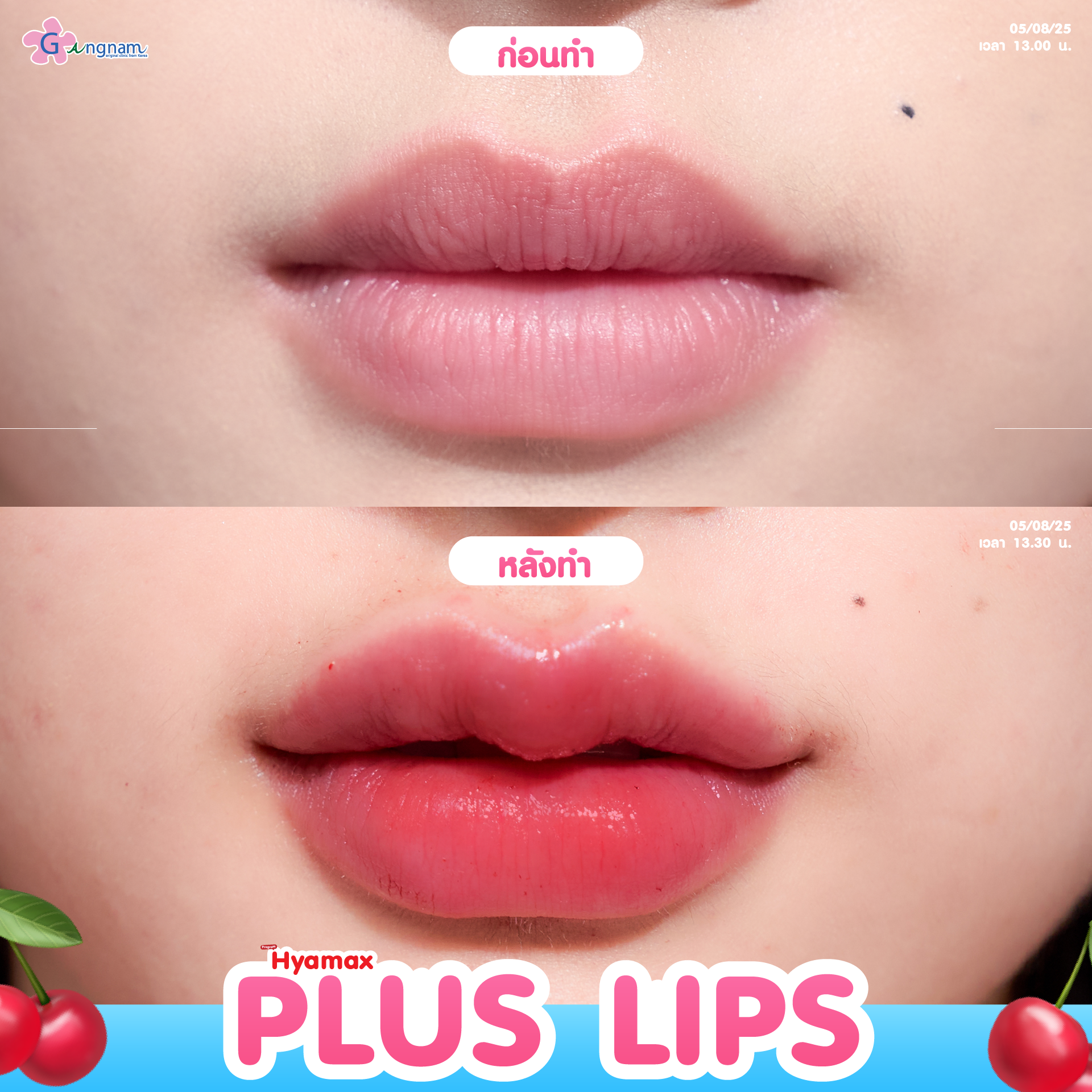 ฟิลเลอร์ปาก กังนัมคลินิก