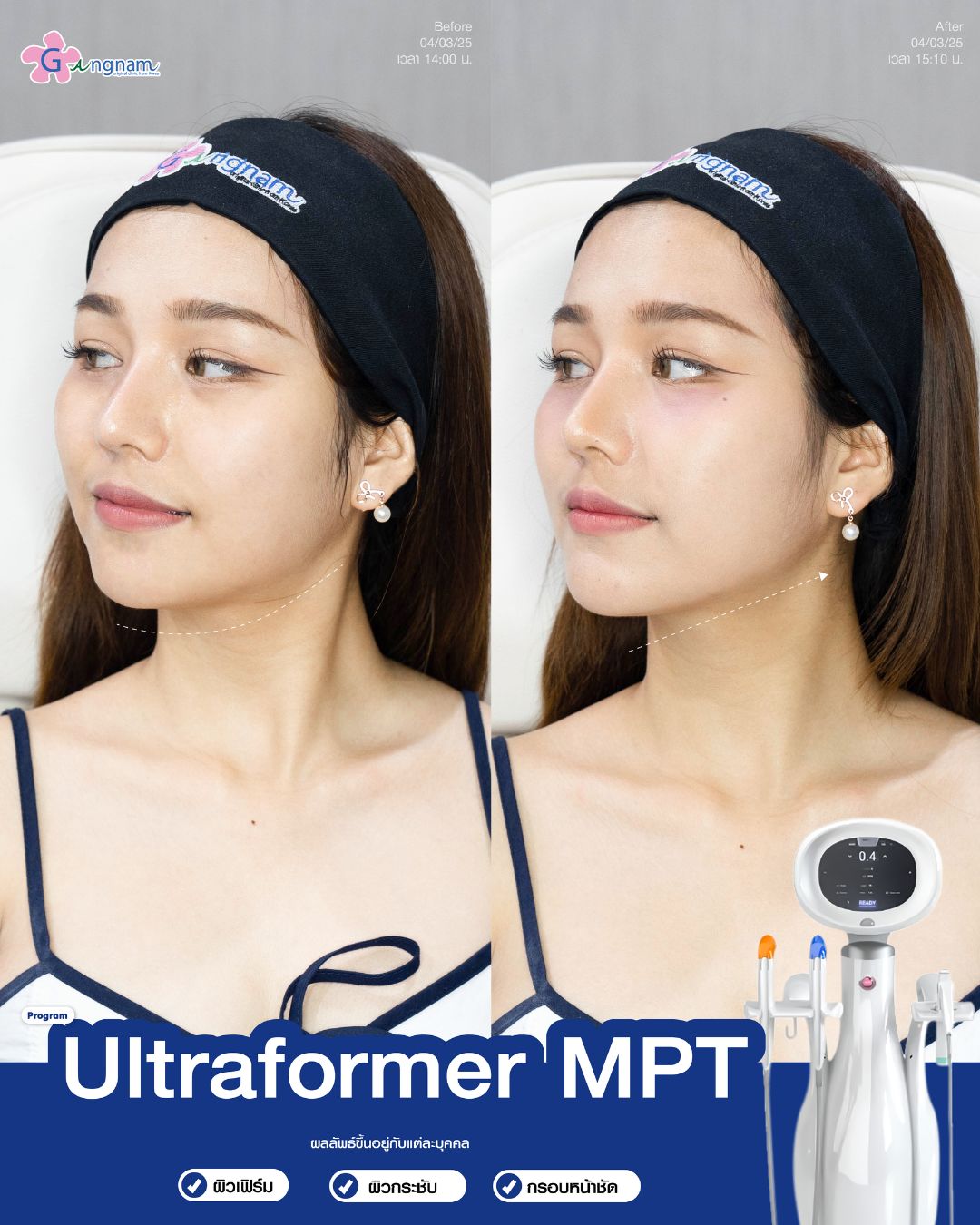 ยกกระชับ กังนัมคลินิก