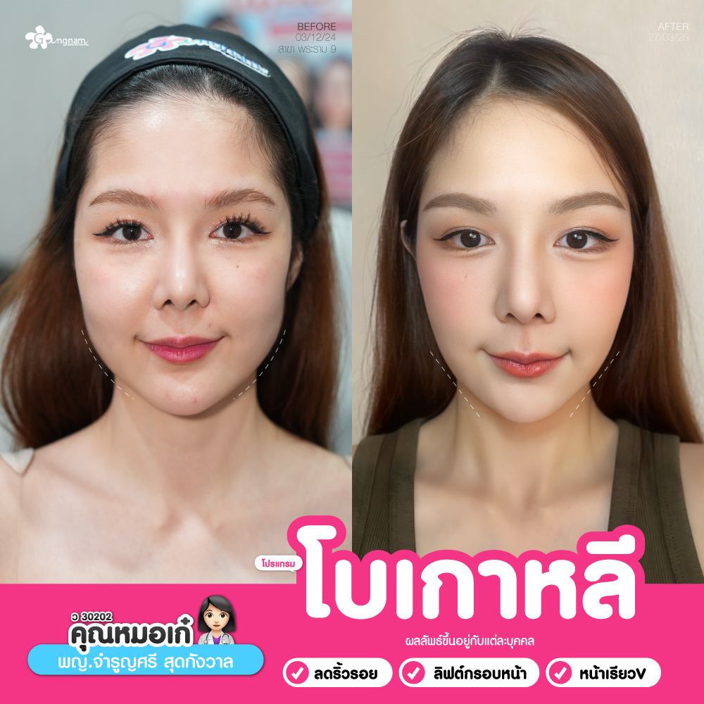 ฉีดโบเกาหลี