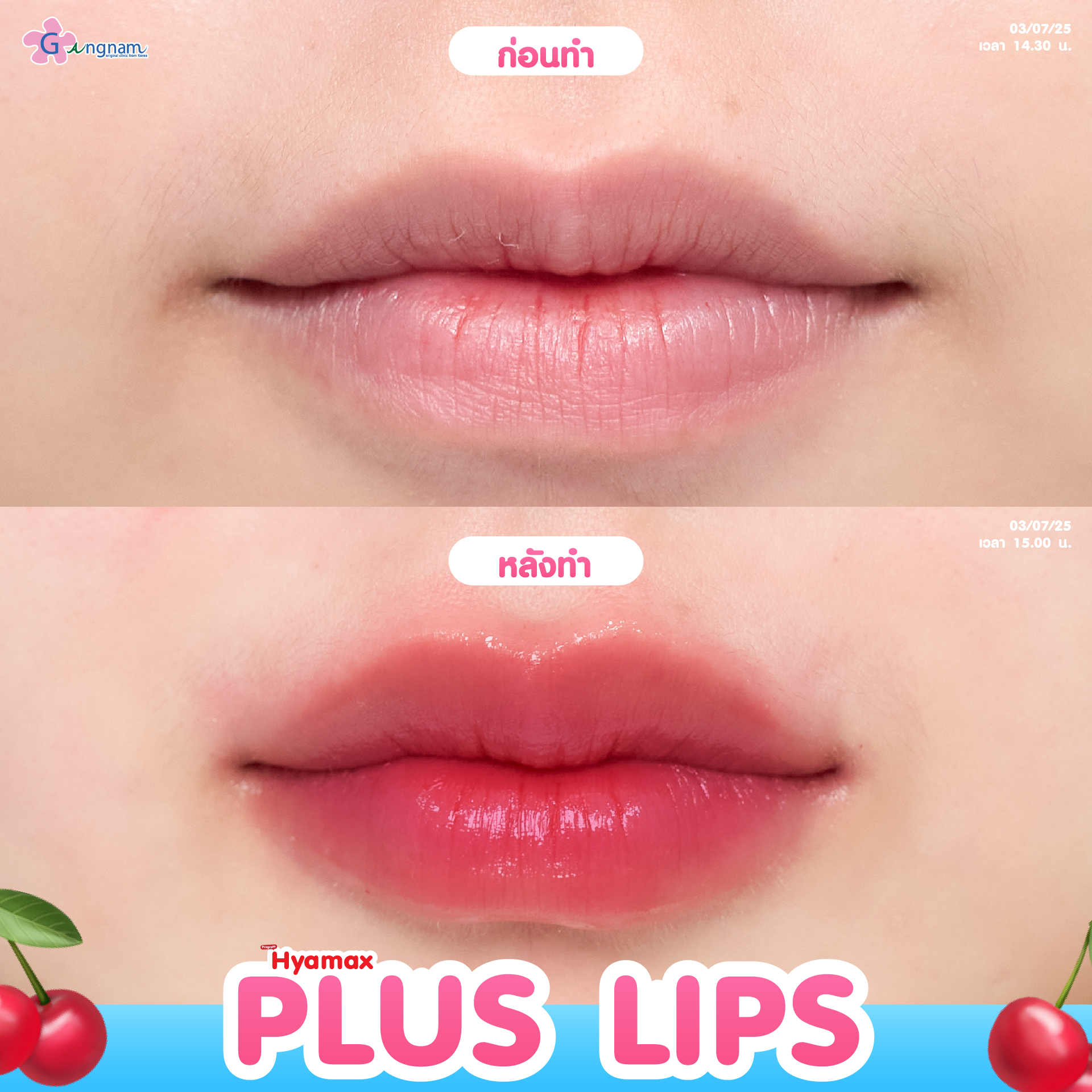 ฉีดปาก กังนัมคลินิก