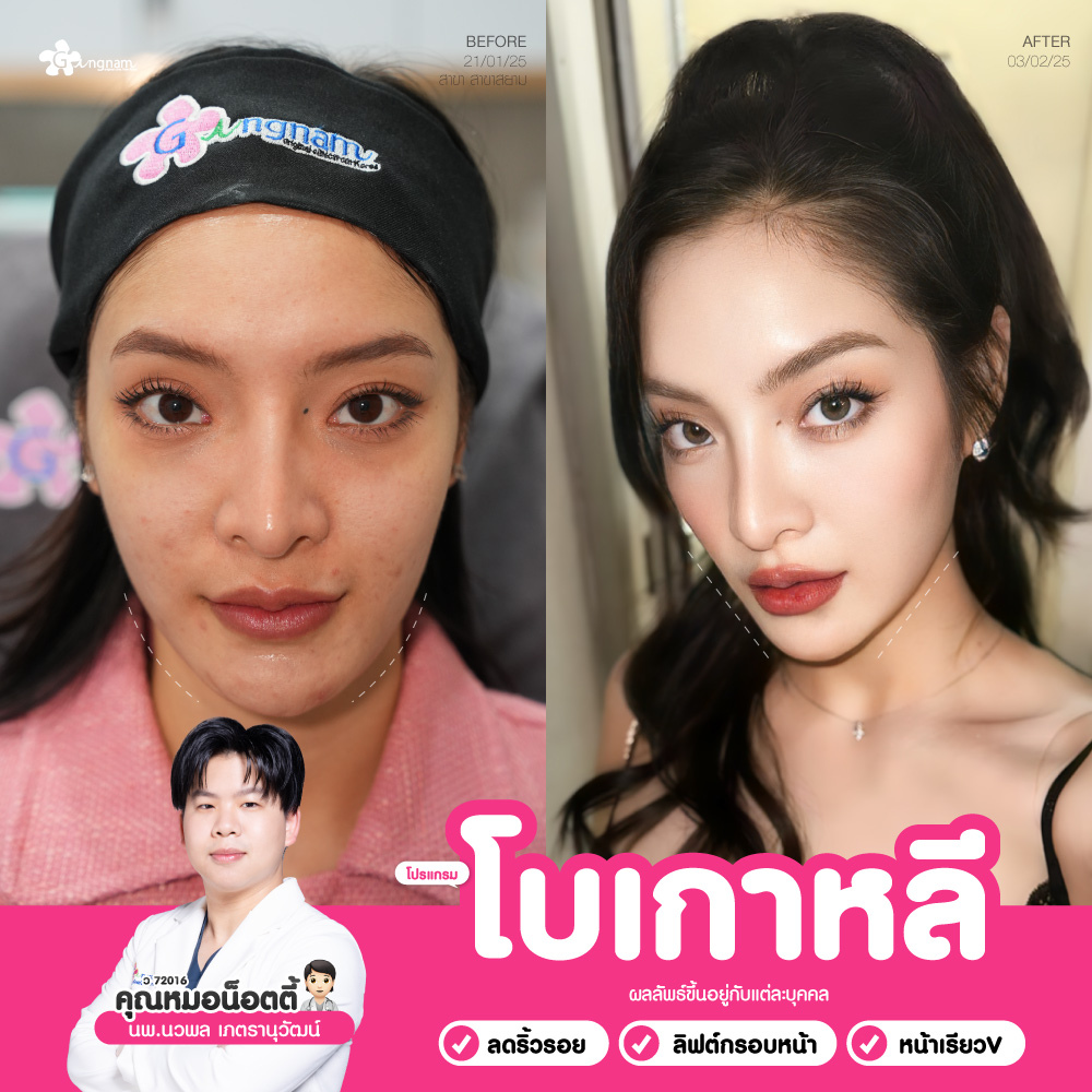 กังนัมคลินิก โบท็อกซ์