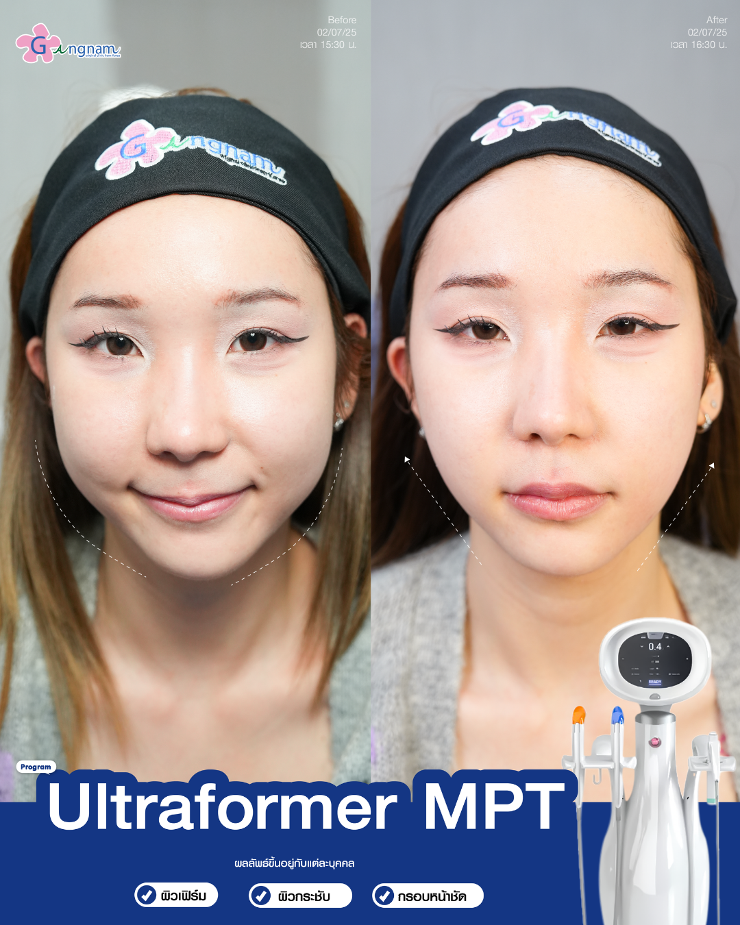 Ultraformer กังนัมคลินิก