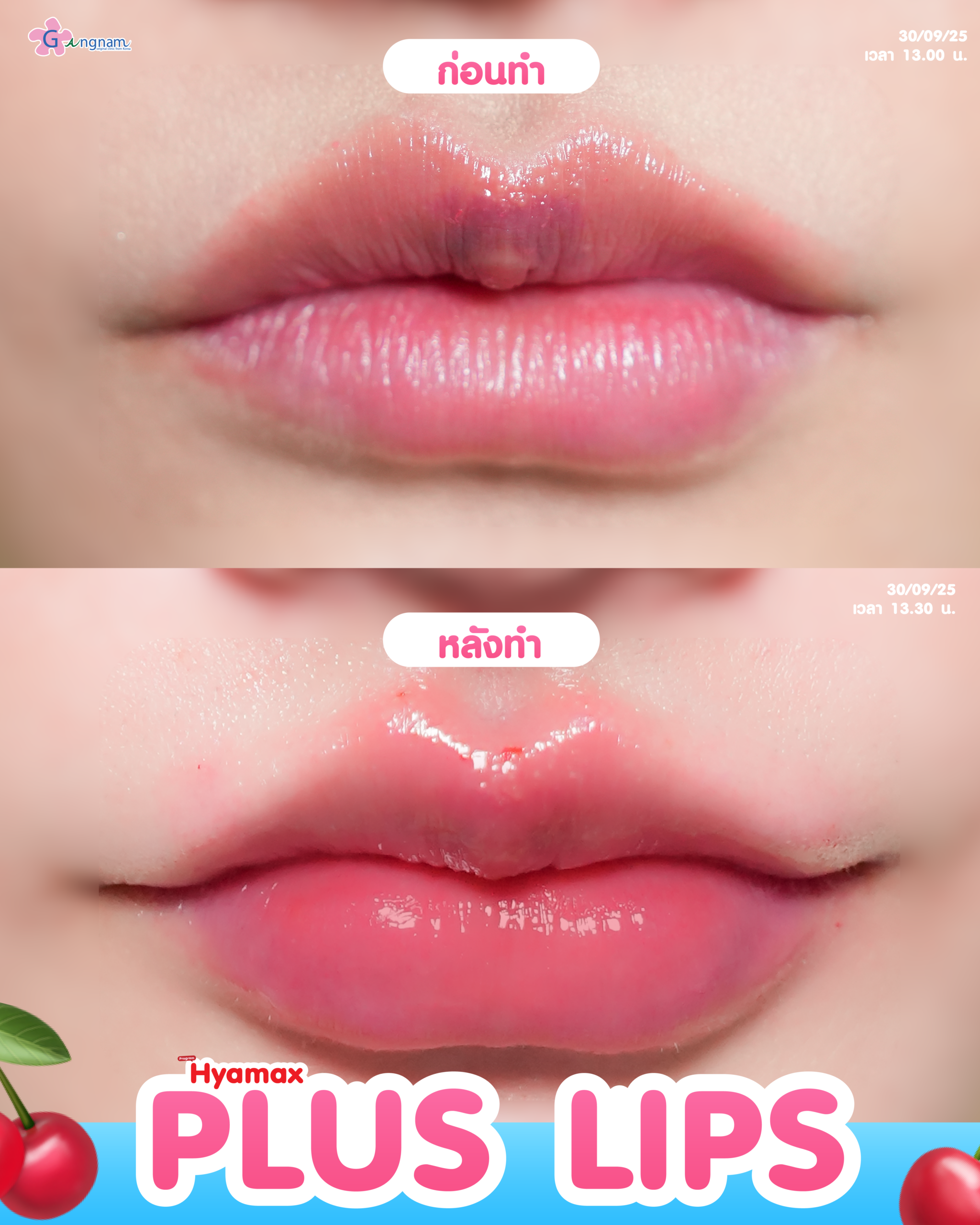 Review Filler ปาก