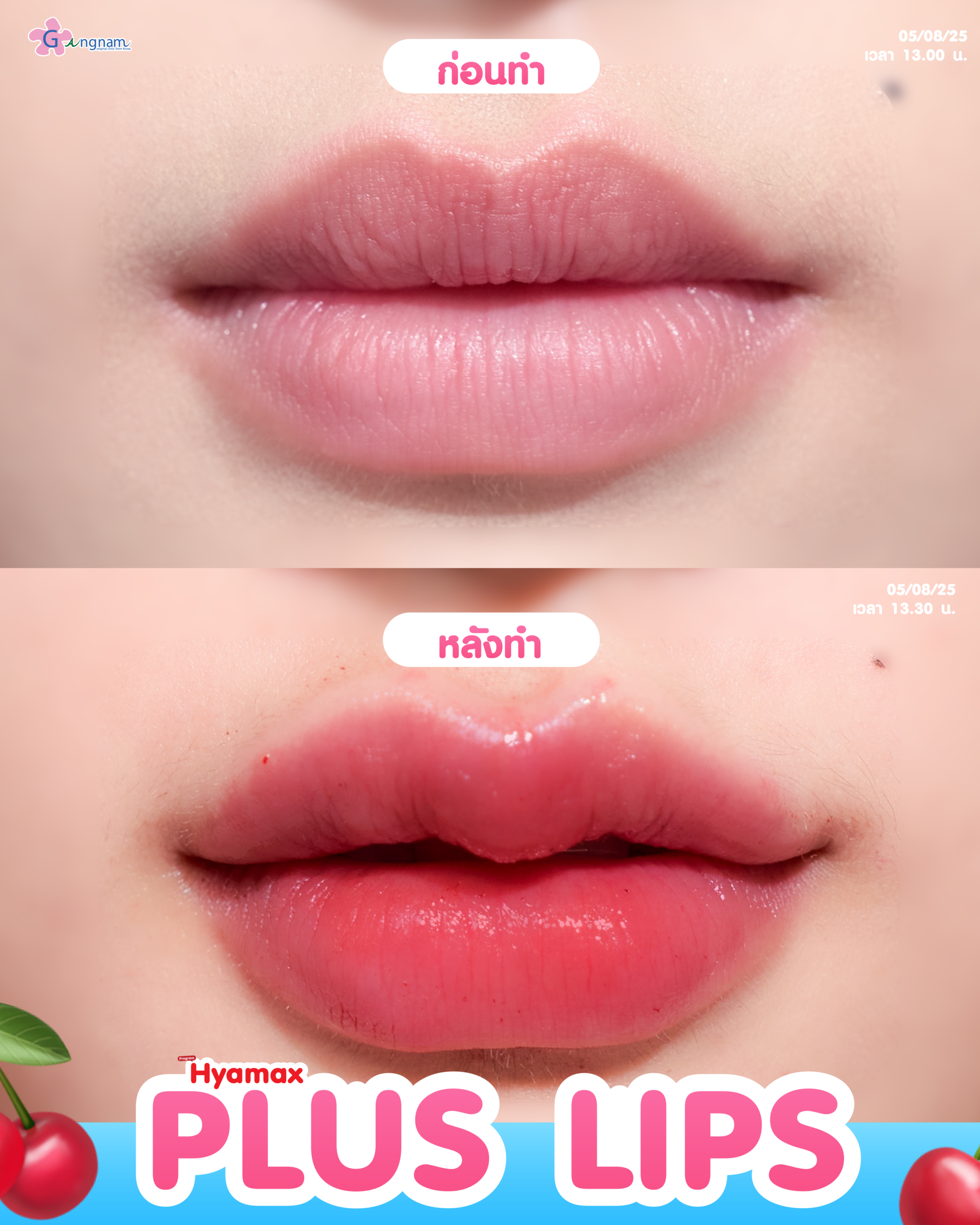 กังนัมคลินิก ฟิลเลอร์