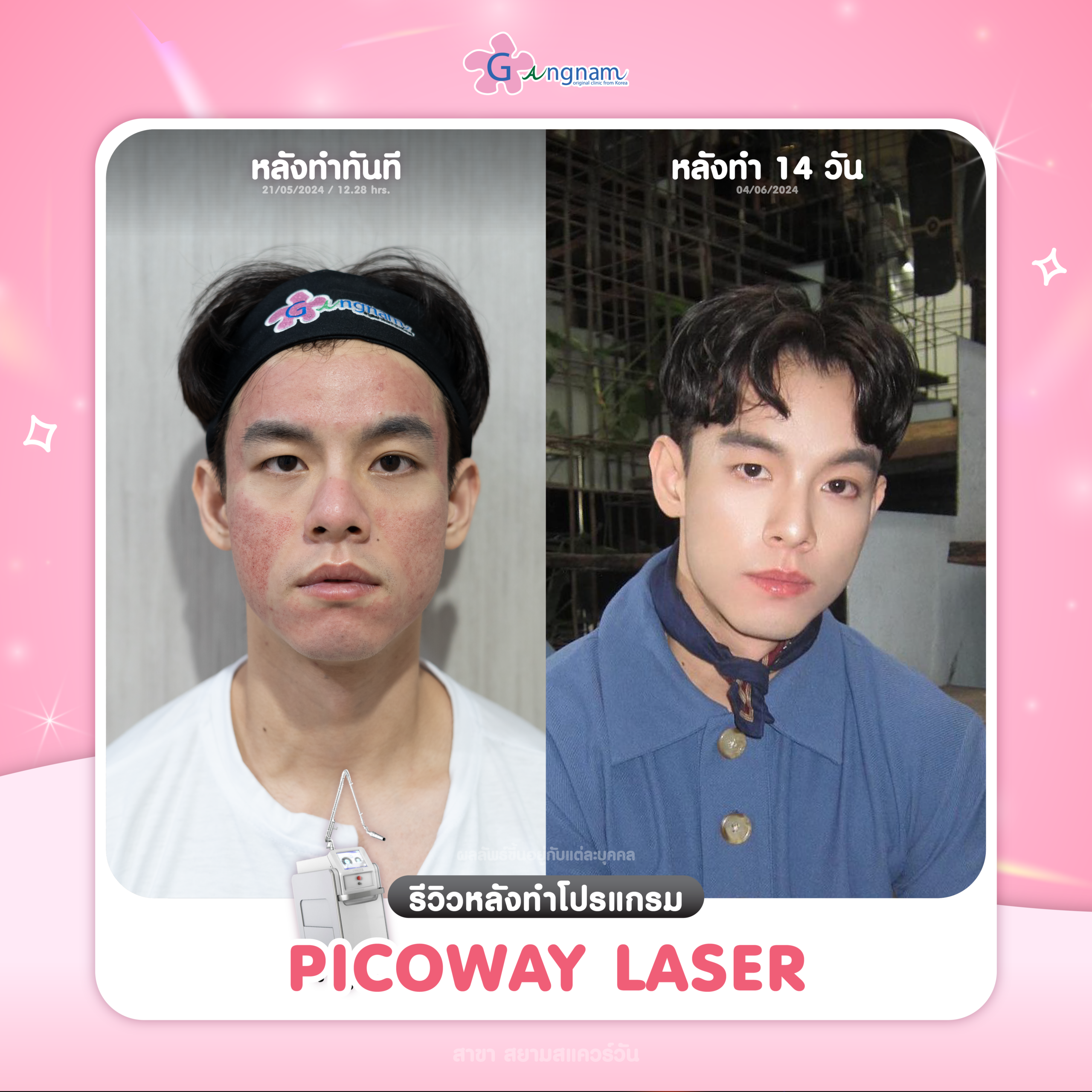 รีวิว Picoway Laser กังนัมคลินิก