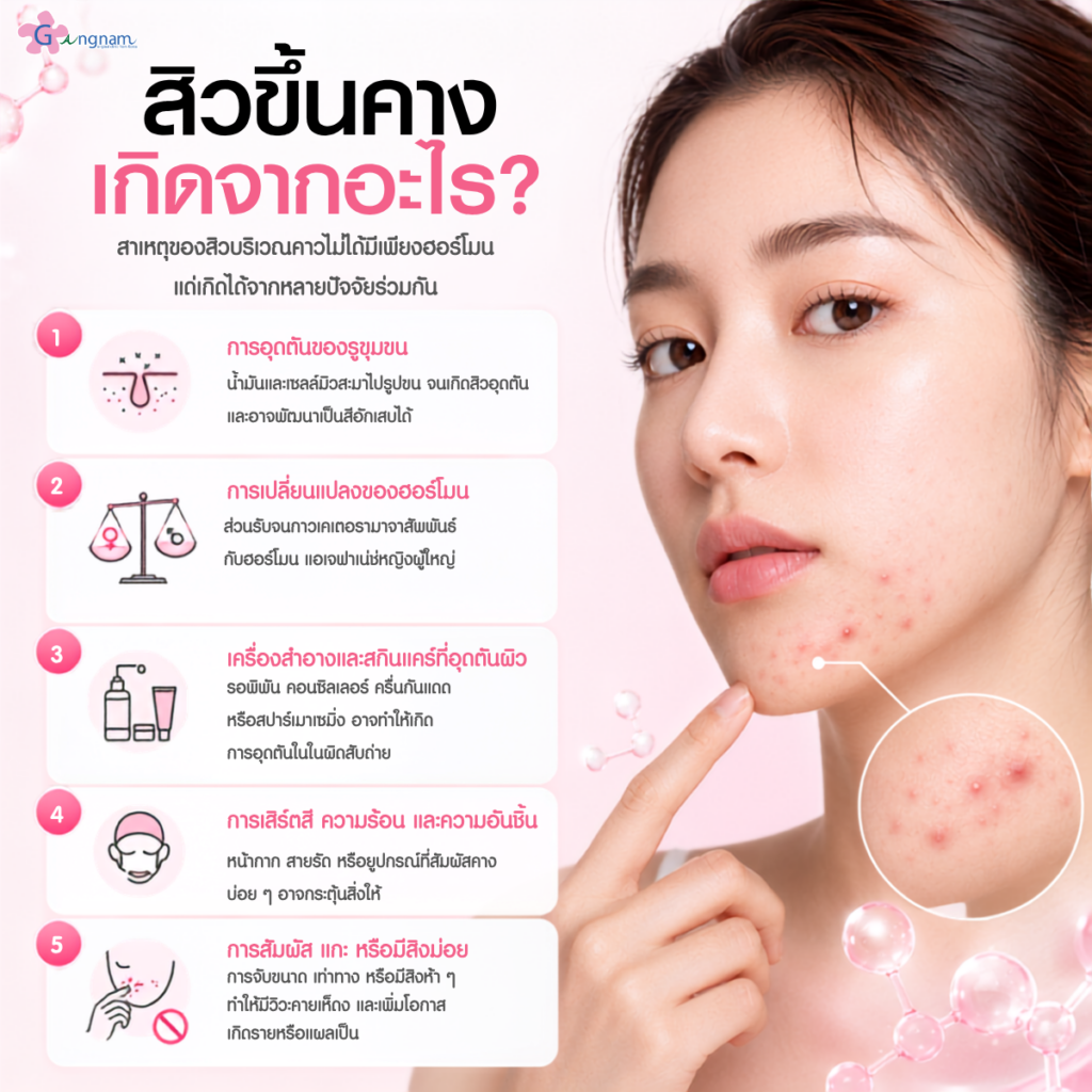 สิวขึ้นคางเกิดจากอะไร?