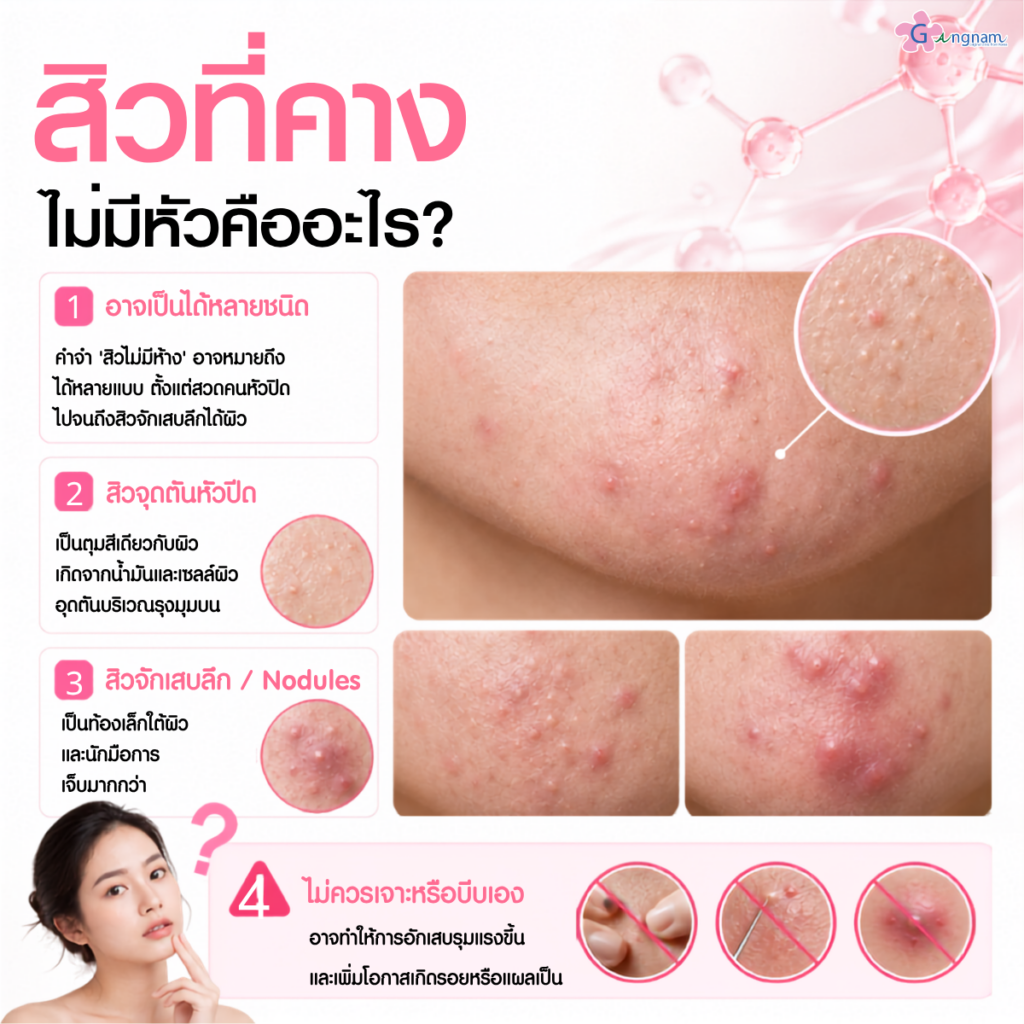 สิวที่คางไม่มีหัวคืออะไร?