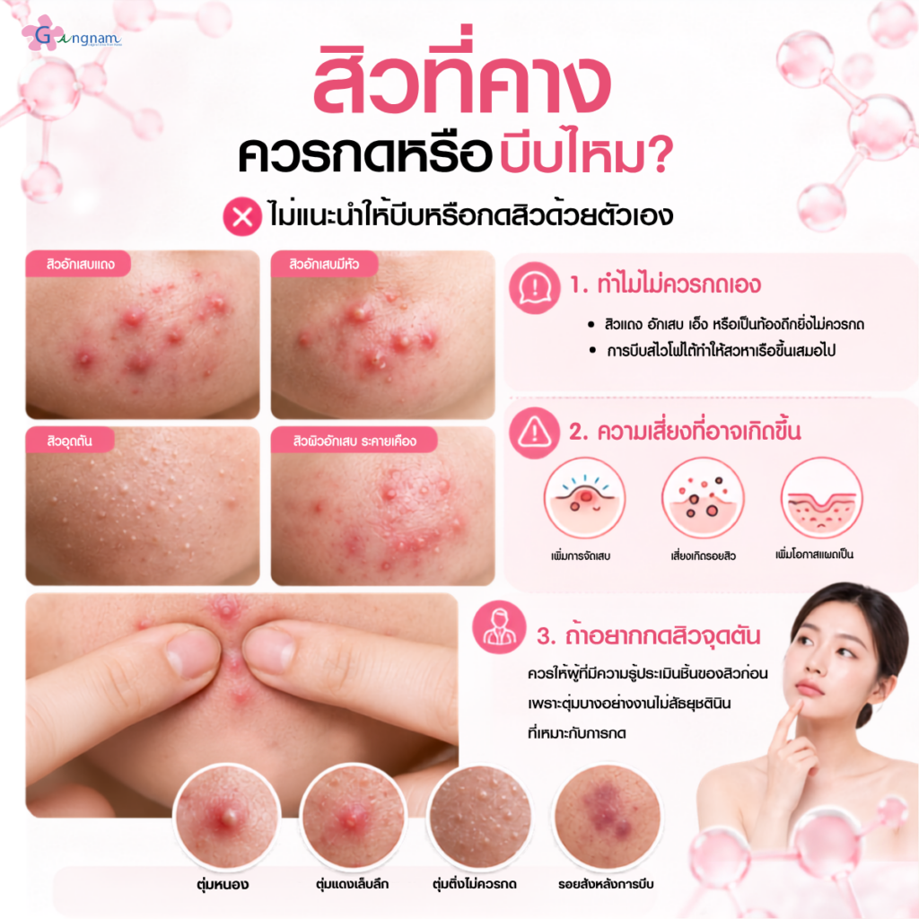 สิวที่คางควรกดหรือบีบไหม?