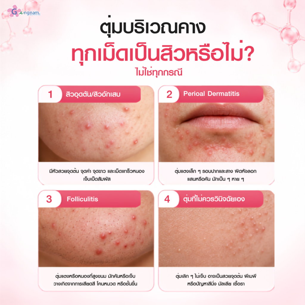 ตุ่มบริเวณคางทุกเม็ดเป็นสิวหรือไม่?